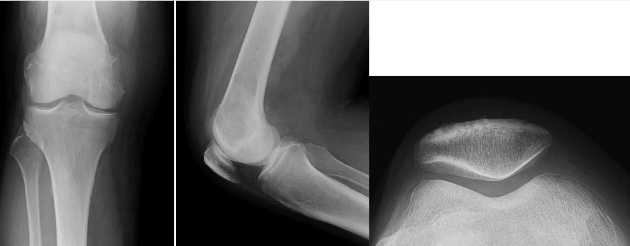 X-ray showing knee from multiple views with lesion infiltrating the femur